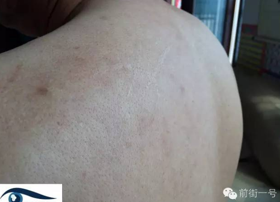 薛凤起后背的疤痕，他称这是被关期间遭公安用皮带、三角带抽打留下的疤痕证据