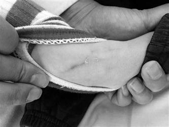 3岁男童化疗42次 发病部位骨头逐渐被侵蚀(图