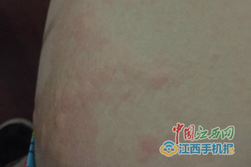 男子住酒店一晚全身起红疹 投诉遇假店长|酒