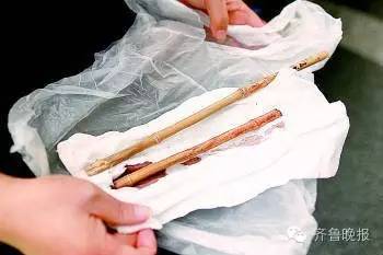 医生从小曲头部取出的竹竿。生活日报记者王鑫摄