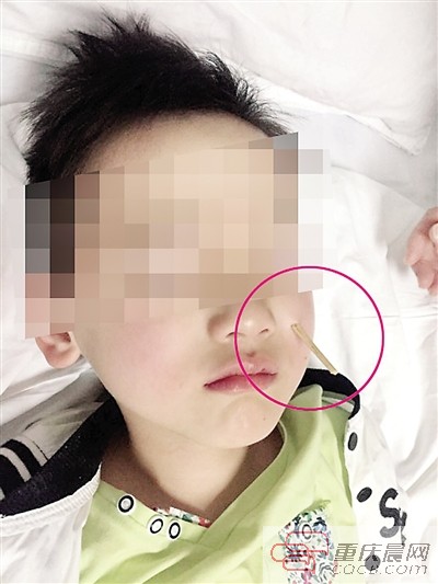 24日，重医附一院，6岁男童小阳左边脸颊被串烤肠的竹签戳穿。 本报记者 杨新宇 摄