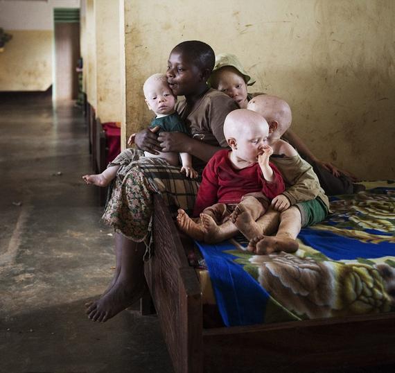 坦桑尼亚白化病患者生活在恐惧中，因为他们的身体器官被卖给巫医，据说能带来好运和财富。27岁的姆巴鲁·约翰（Mbalu John）有4个患白化病的孩子，他们都住在卡班加（Kabanga）学校中，这里是白化病患者的安全屋。