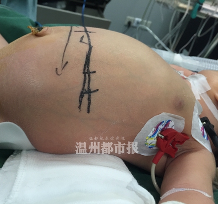 出生不久的女婴肚里怀着另一个胎儿