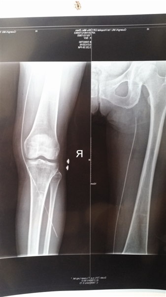 X光片显示，有长约30厘米的导丝留在吴女士右腿血管内。