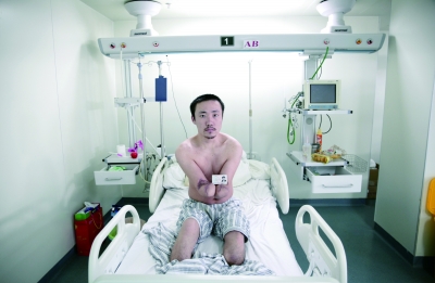 小伙打工时遭电击被截去四肢 求职因无假肢搁浅|截肢