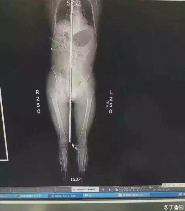 螺纹钢筋经会阴纵穿头顶。