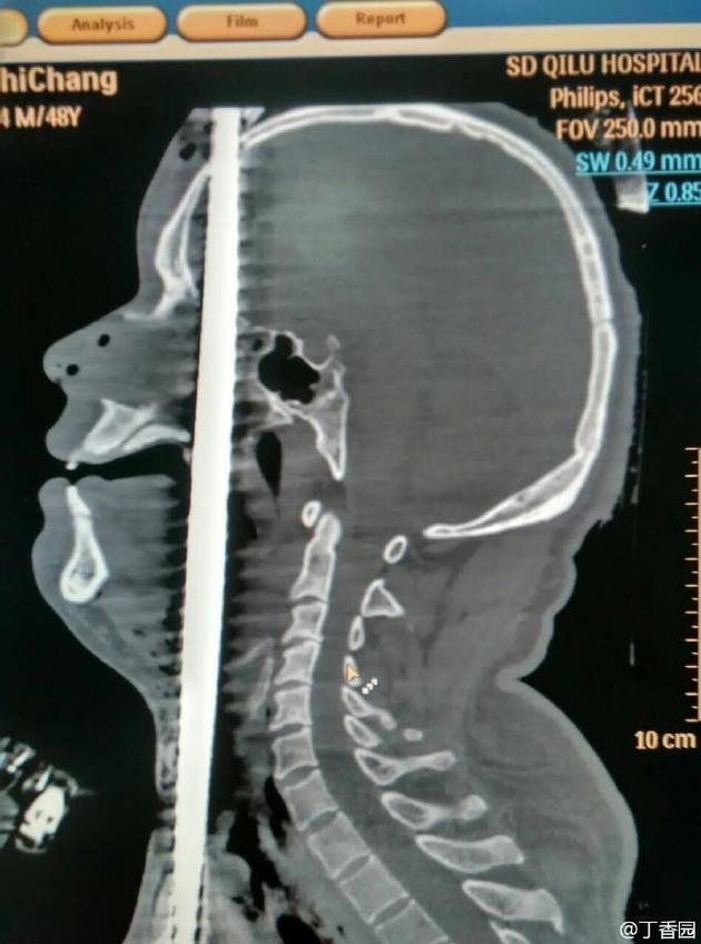 螺纹钢筋在头部