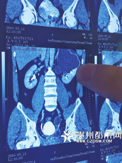 影像检查　资料显示，王开炼有4个肾，黑色阴影部分就是感染的左上肾。右边的两个肾在这份资料上已经重叠，看起来并不明显。