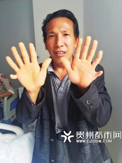 刘天书双手上的多指情况，他的每只手都有6个指头。