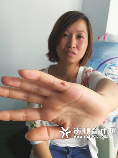 王开仙的左手也有6个指头，虽然已被弄断，但这个“小肉丁”也很明显。