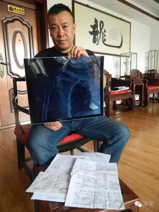 刘福增展示其被砍伤后，在医院接受救治时所拍摄的X光片
