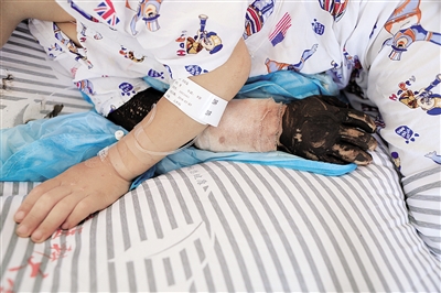 磊磊受伤的右手臂上敷着治疗蛇毒的药物。