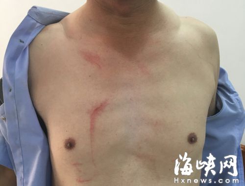 民警被打伤的伤口