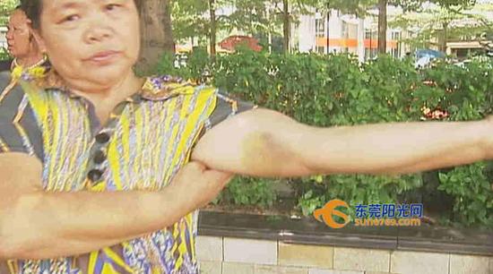 刘阿姨向记者展示自己手臂上的瘀伤