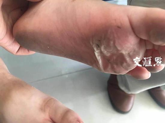 3岁男童脚底被烫伤