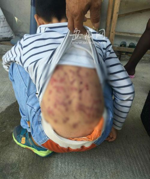 日前，宁国市梅林镇一名长期遭受生母男友家暴的10岁男童，引发社会广泛关注。  安徽网 图