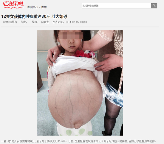 但是通过搜索发现,其实这张照片配图出自2014年7月的一则女孩患肿瘤的报道。