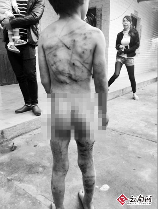 图为孩子身上的伤痕。