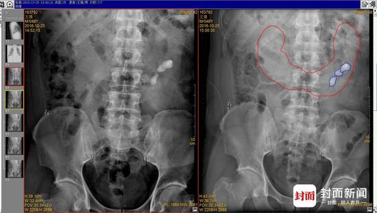 王先生术前X光示意图(红色为马蹄肾基本轮廓，蓝色为结石轮廓)