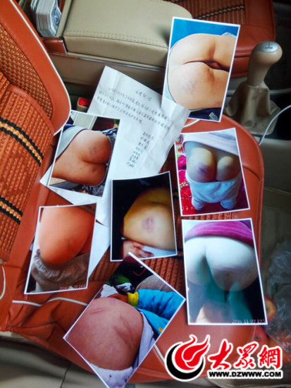 王先生提供的7名孩子屁股受伤的照片