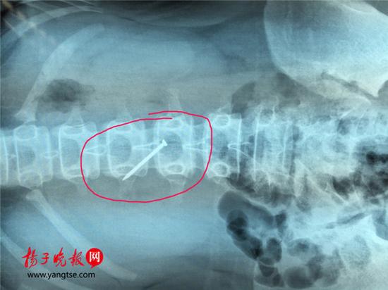 长约4厘米的铁钉被取出时，已刺穿13岁女生的胃壁。