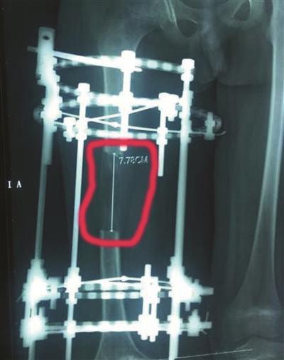 牵引架将断骨处拉开，3个月增加近8厘米。