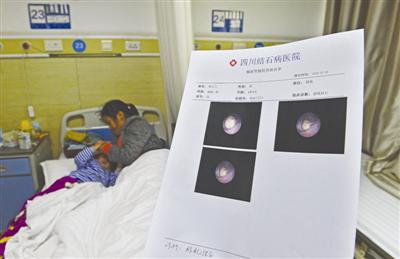 强强住进四川结石病医院，输尿管镜检查报告单显示：临床诊断为膀胱结石