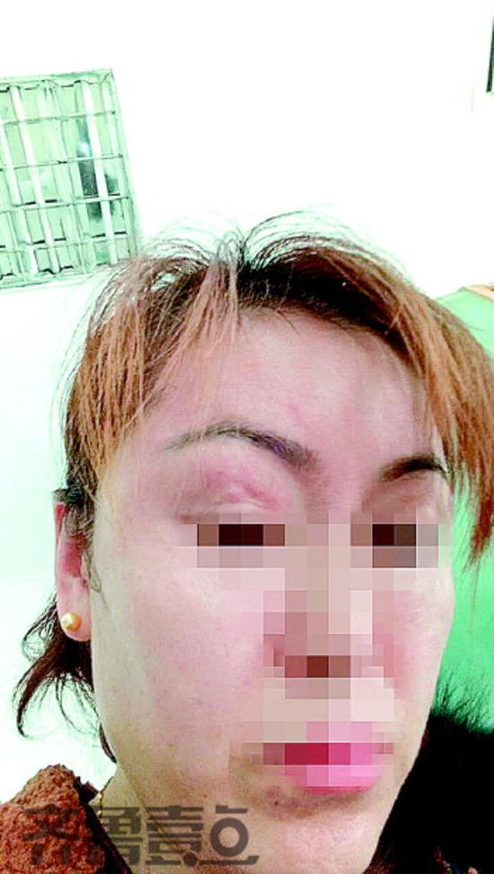 齐女士脸被拉长，眼皮里有疙瘩