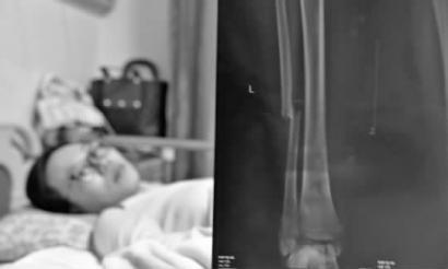 X光显示刘女士腿部的一个骨折部位