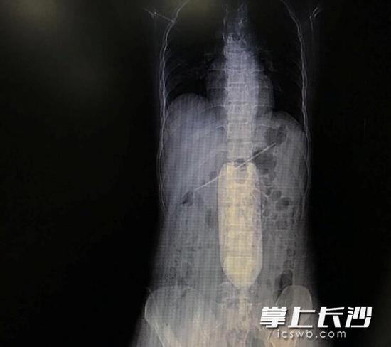 CT显示，李莉吞下的毛衣针已造成她胃穿孔。