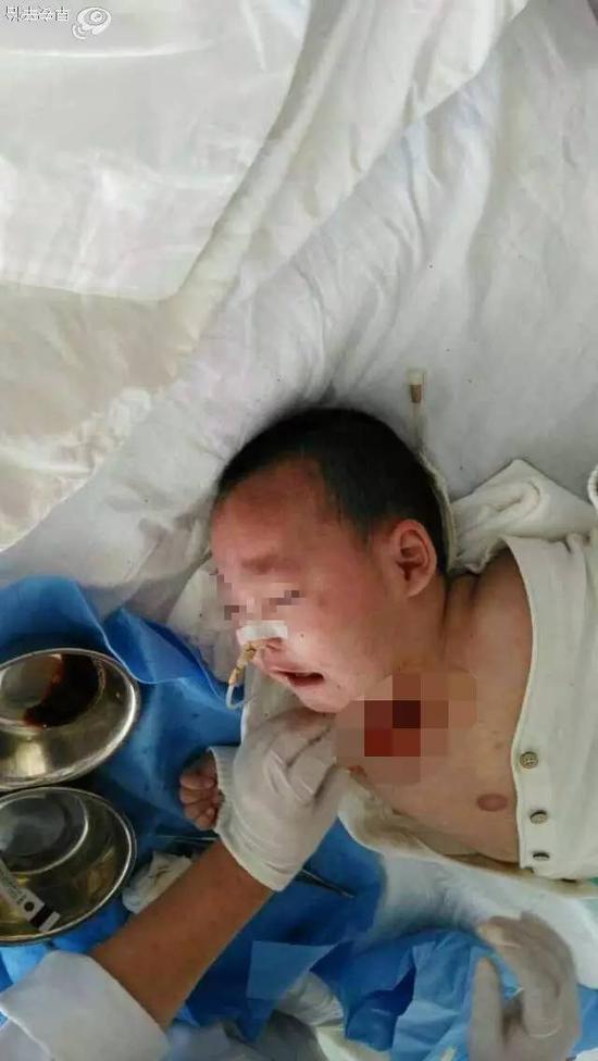 洛阳-无钱治疗,回家后喉管化脓