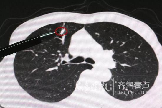 “子弹”距肺上叶血管仅1毫米