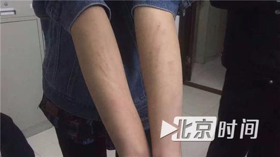 女记者手腕附近出现淤青