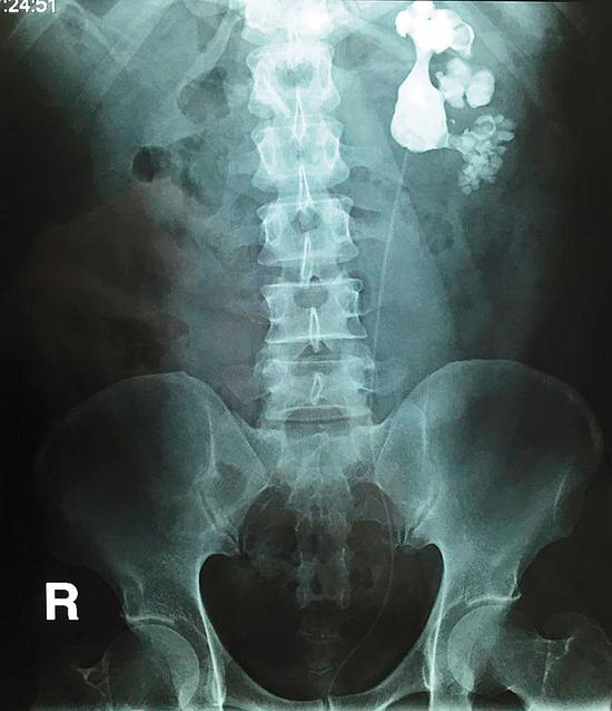 （CT片上显示肾里塞满了结石）