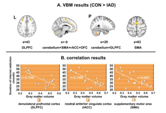 图三 A. 网络成瘾青少年的大脑灰质体积减少；B. 三个大脑区域的灰质体积与网络成瘾时间显著负相关