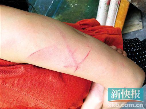 阿雯手臂上的伤痕清晰可见。 受访者供图