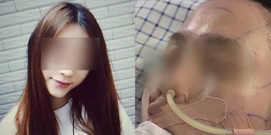 23岁女子面部整形突发意外 已昏迷超过48小时