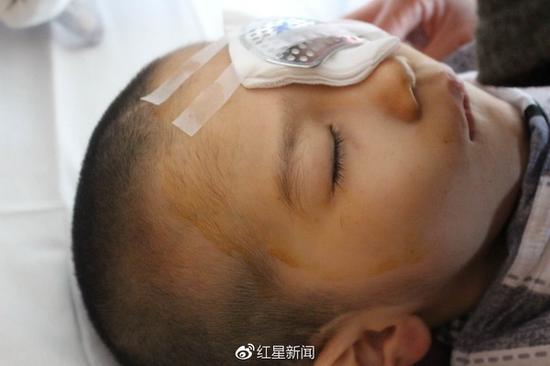 6岁男童遭继母毒手75%颅骨缺损 现已接受眼部手术