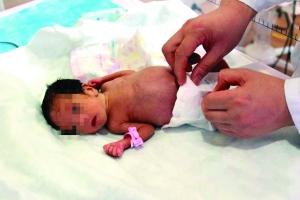 女子怀孕25周产下的掌心宝宝被救活:出生仅千余克