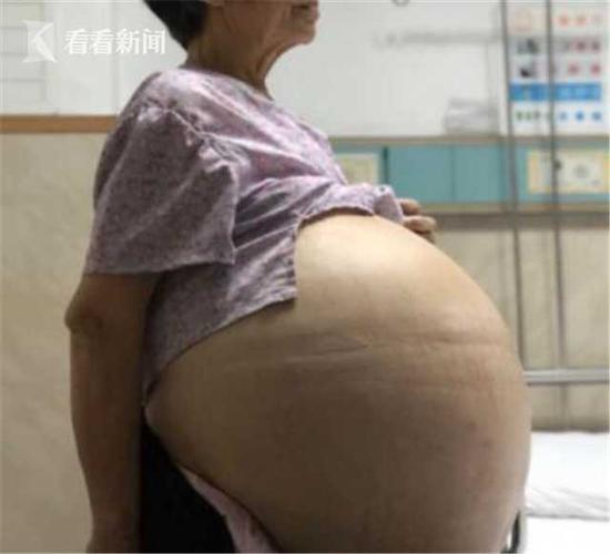 69岁大妈患妇科肿瘤肚鼓如球 医生抽出30多升囊液