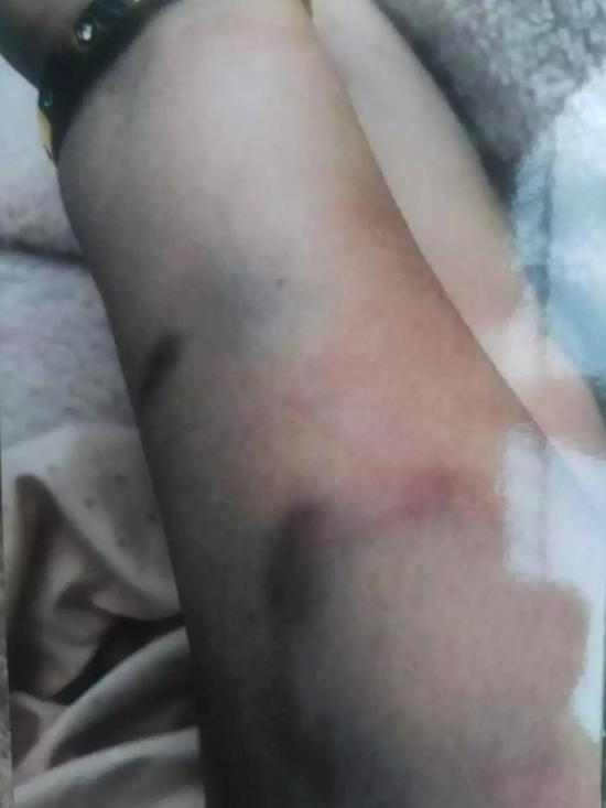 (当时王燕茹被打的伤)