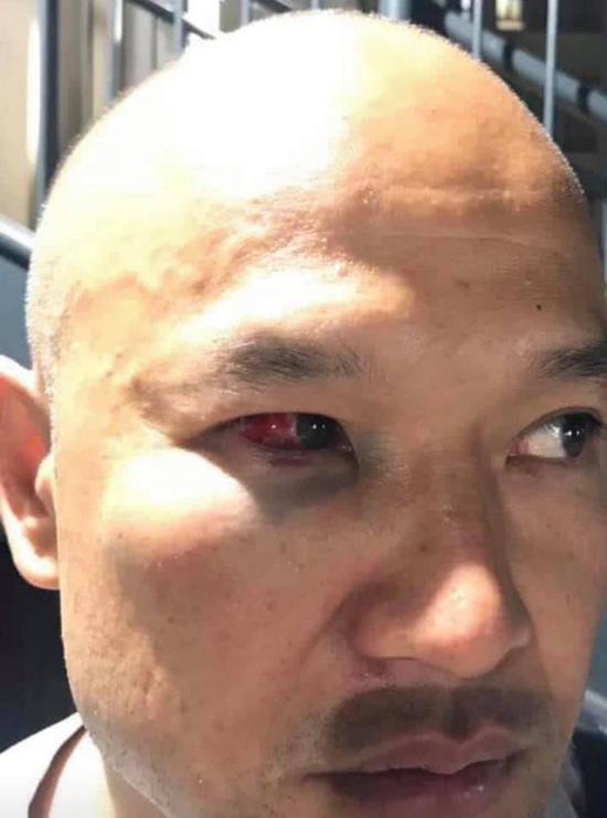 照片显示,白衣警察刘Sir的眼眶已经充血 港媒图