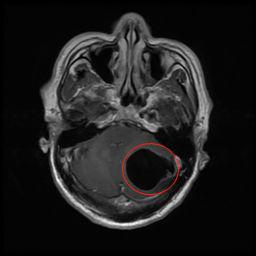 （术前头部MR，左侧小脑半球内一较大的囊性占位，压迫小脑、脑干，为囊虫病变。“黑色空洞”部分即为囊虫病灶）