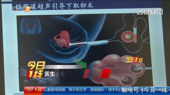 地下代孕黑链调查：出租屋取卵 85万一条龙包成