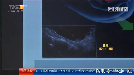 地下代孕黑链调查：出租屋取卵 85万一条龙包成