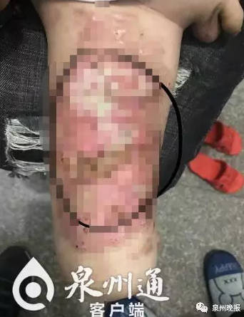小凯被沸水烫伤的腿