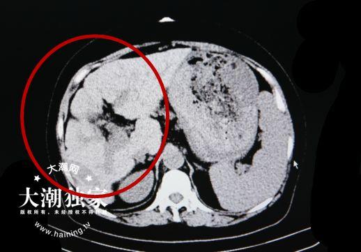 △王女士腹部CT检查报告（红圈为肝脏所在位置）