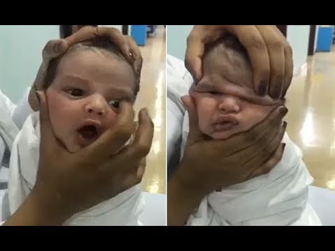残忍！护士挤压婴儿的脖子和头取乐 孩子整张脸变形