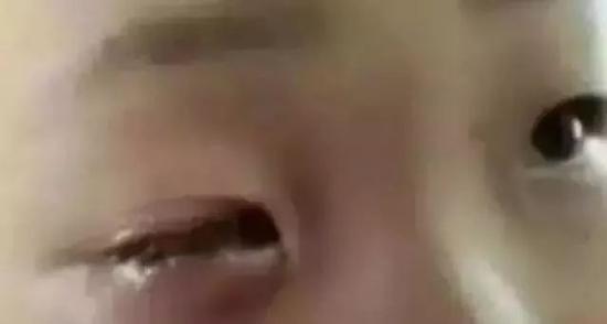 孩阁下眼被消融
