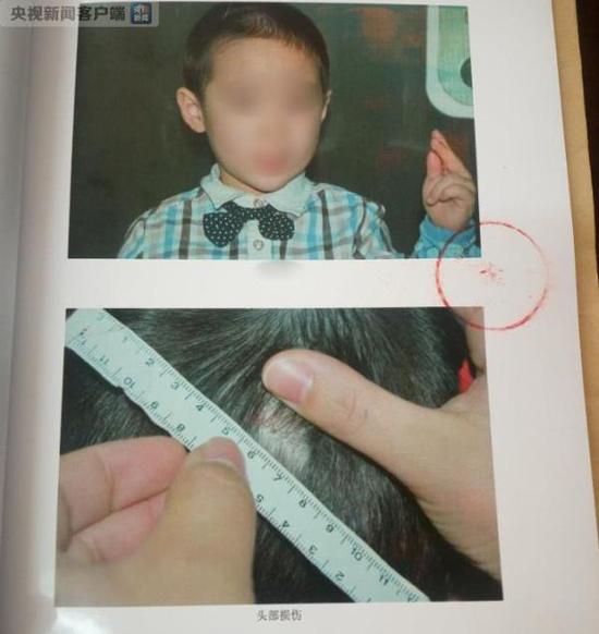 吉林四平红黄蓝幼儿园受伤儿童鉴定。 央视新闻客户端 图